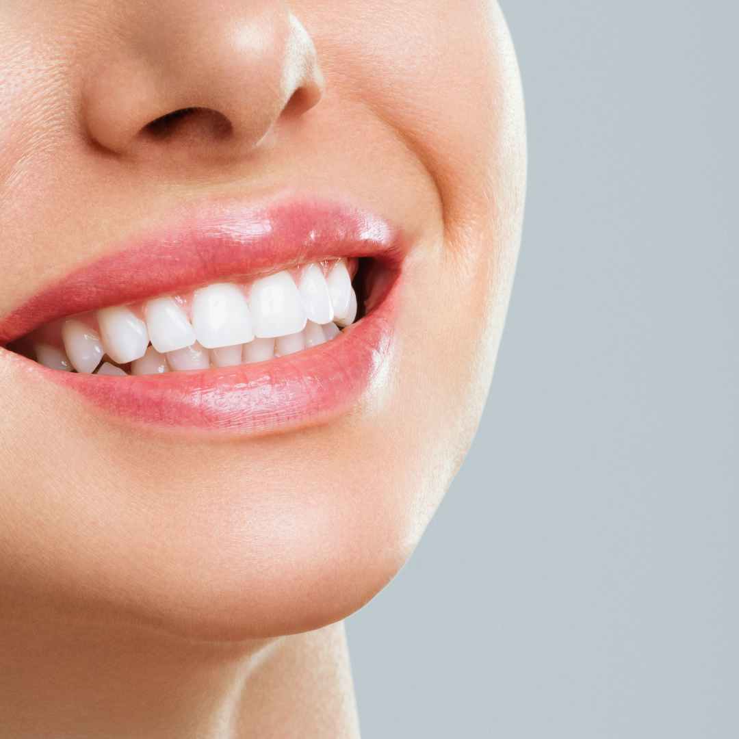 Composite Bonding