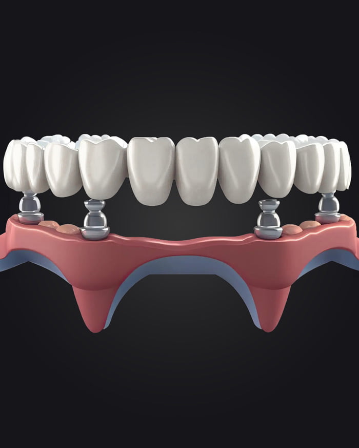 Dental Implants